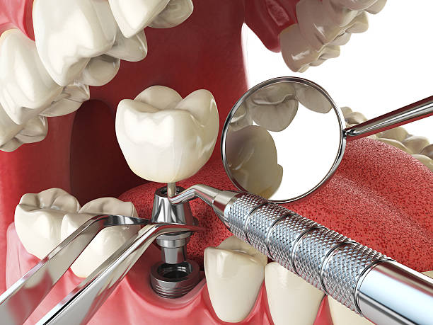 Best Broken or Chipped Tooth Repair in Mcrae Helena, GA